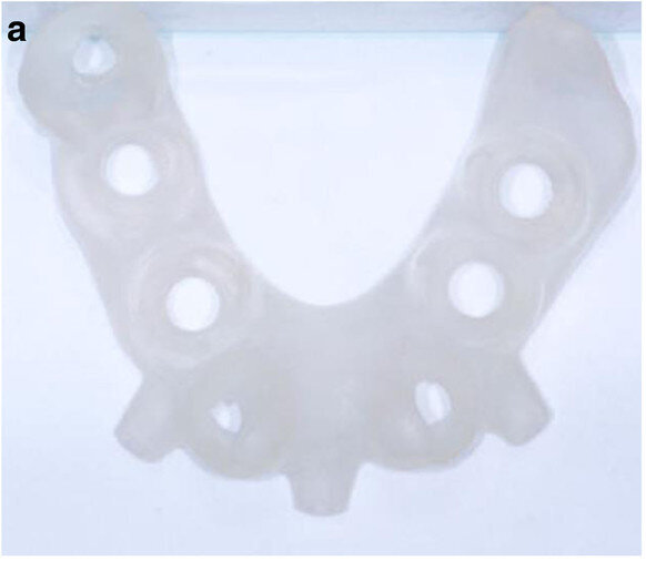 Fig. 5a: CAD/
CAM-fabricated surgical guides: tooth- and mucosa- supported (a) and implant- and mucosa-supported (b).