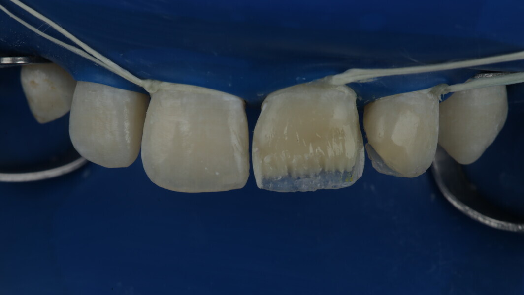 Fig 27: A2 Body was used to build the mid layer and multiple lobes were created to mimic the adjacent tooth.