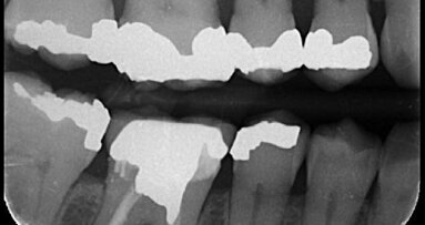 Managing maxillary molars