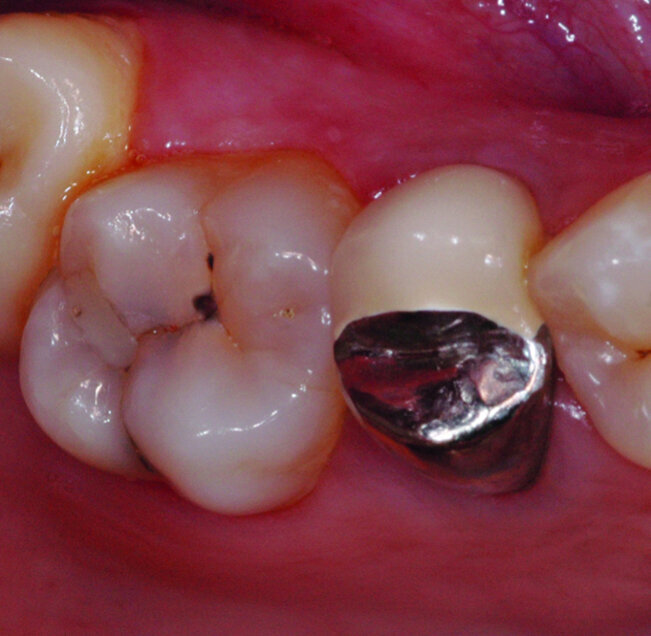 Fig.10 : Vue occlusale pre-operatoire objectivant une lesion carieuse sur 26. 