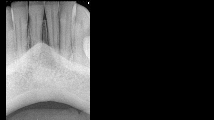 Slika 1: Radiografija pacijentkinje pre operacije.