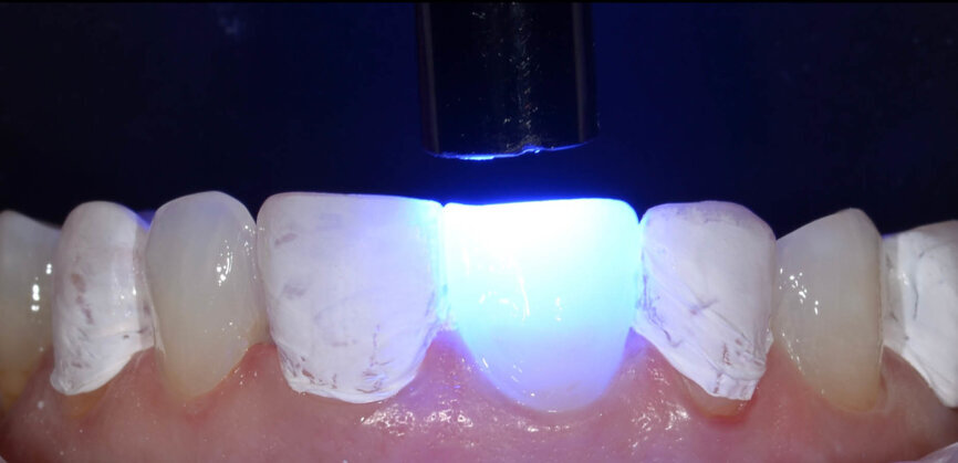 Fig. 9: Each bonded tooth was light-polymerised for 10 seconds. 