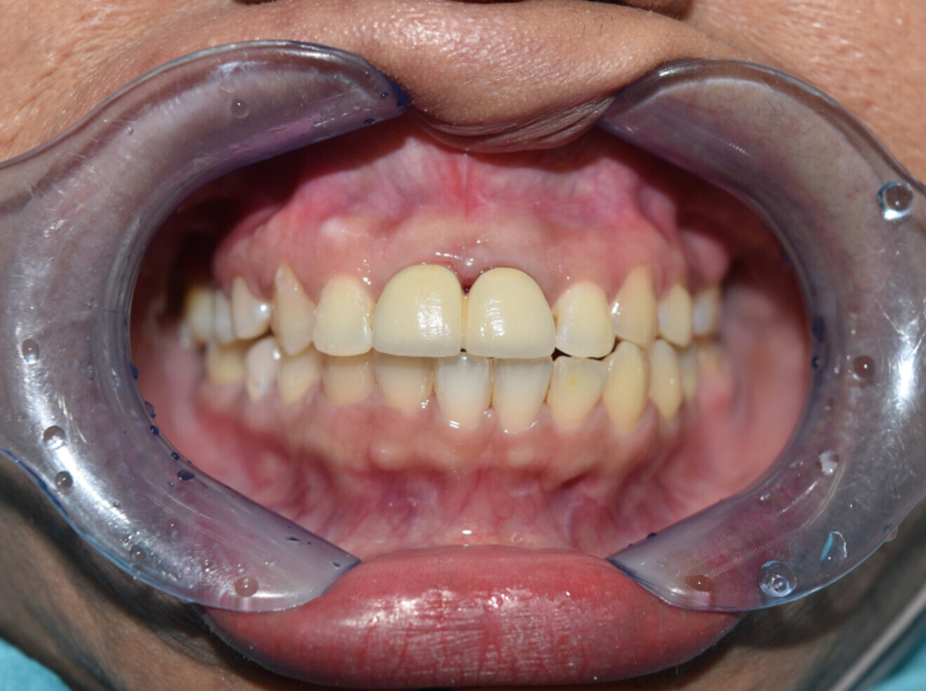 Fig. 12c: 2-unit porcelain fused  metal bridge prepared.