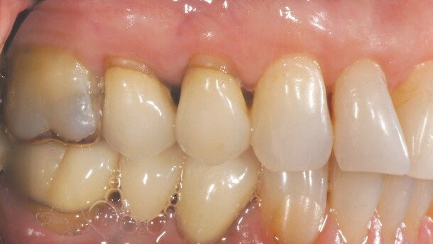 Using in-office CAD/CAM technology and lithium disilicate to fabricate efficient and predictable restorations