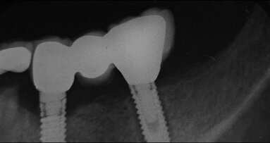 Jednoznačná indikace CBCT v distální části mandibuly
