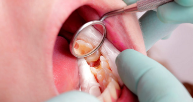 Европейските експерти се обединяват, за да спрат кариеса