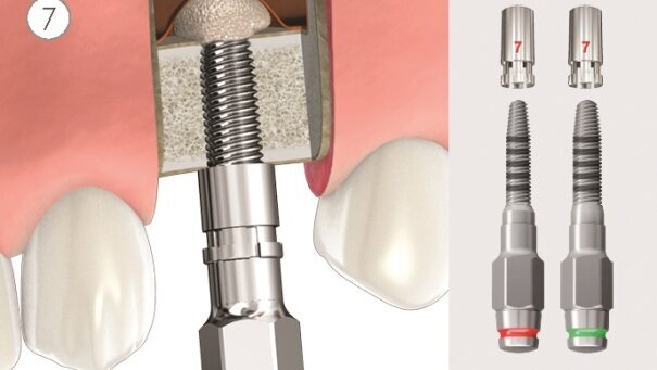 Mini sinus lift (podizanje poda sinusa), krestalni pristup - tehnika duravit crestal sinus lift by B&B DENTAL