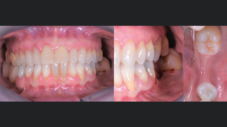 Fig. 1 - Aspetto clinico dell’atrofia orizzontale a livello dell’elemento 36 estratto alcuni anni prima.