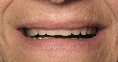 ¿Sabes cómo copiar y pegar una prótesis completa? (1)