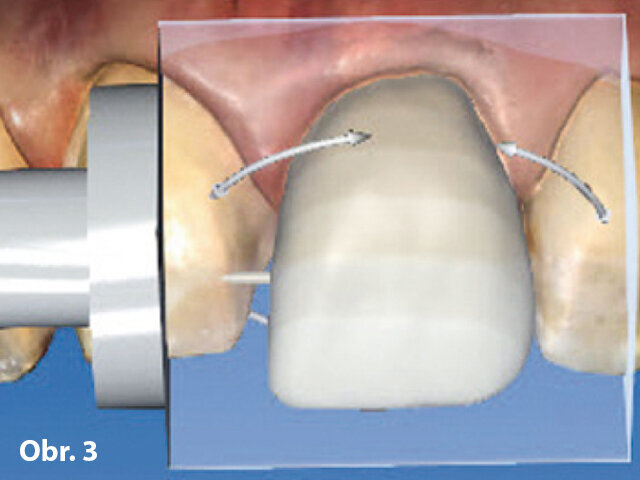 Obr. 3: Umístění konstrukce do bločku