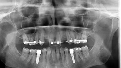 Casus: complexe implantologiebehandeling
