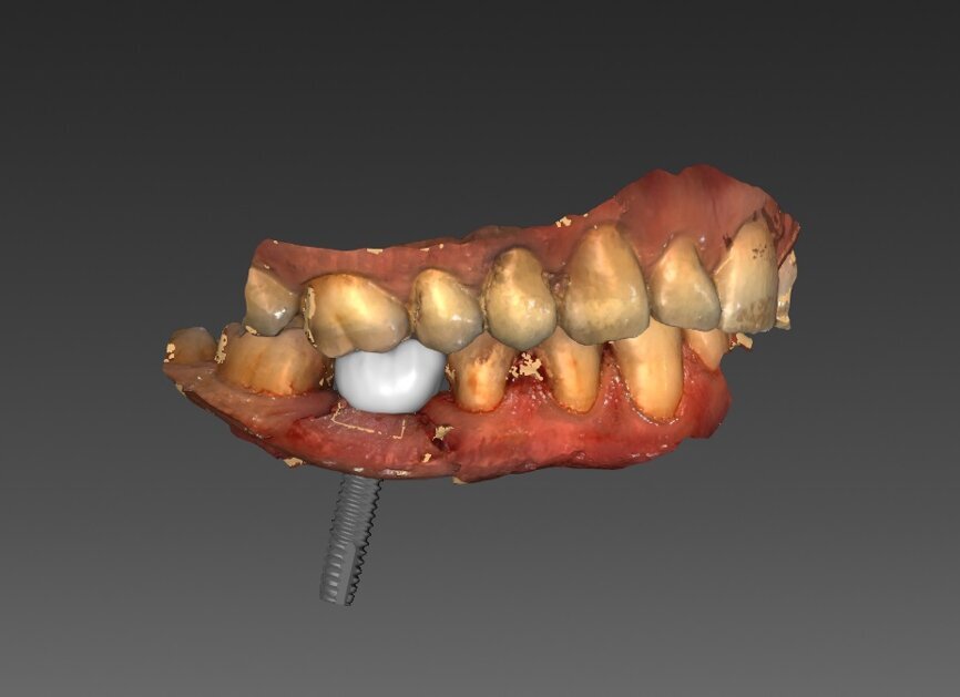 Ryc. 29-32_Projekt korony tymczasowej przykręcanej