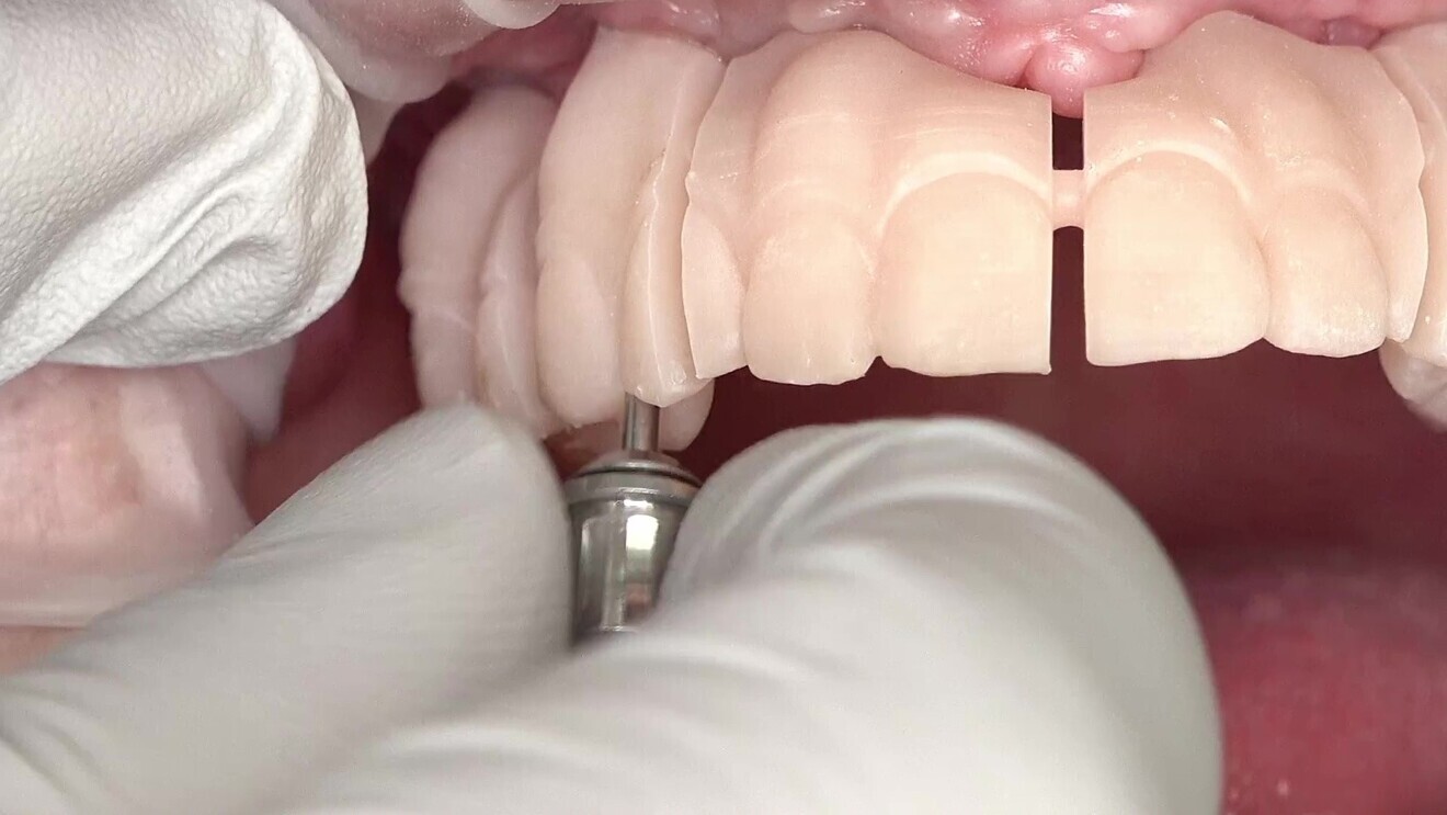 Fig. 8: Seating of the validator try-in in the patient’s mouth.