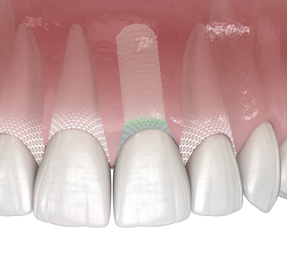 Symbionic teeth are tooth-root-shaped medical devices designed for tooth replacement. Featuring an endosseous and a transmucosal zone, they are anchored in the jawbone and restored with crowns. Unlike traditional dental implants, they form a mucosal defence barrier by bonding with surrounding soft tissue, thereby preventing plaque migration and bacterial invasion.