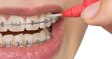 Aparat ortodontyczny i higiena