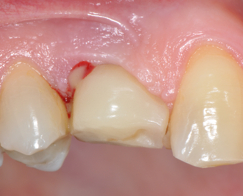 Fig.2: Case 1. BOP starts immediately after probing.