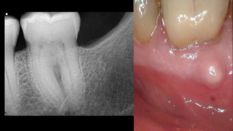 Sl. 8a: Radiografija pre operacije koja prikazuje kalcifikovanu pulpnu komoru i radiolucenciju u oblasti bifurkacije; Sl. 8b: Radiografija pre operacije koja pokazuje fistulu okrenutu ka koronarnom delu kanala korena