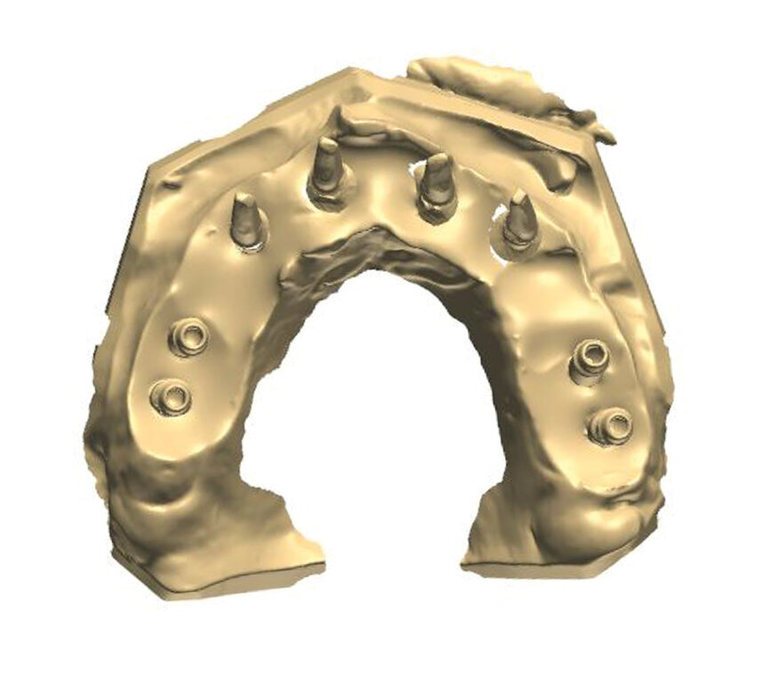 Fig. 5: Design of the framework visible from the palatal side. Visible abutments prior to the placement of telescopic crowns at the frontal section with abutments to be attached by
means of screws at the lateral section.