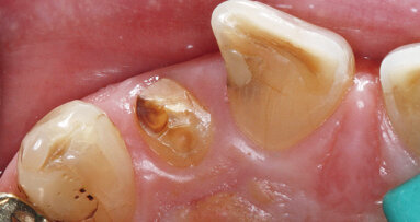 Keramické implantáty: Včera vize, dnes reálná výzva?