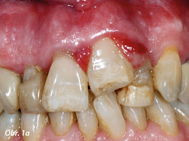 Traumatická intruze, laser byl použit před ortodontickou extruzí kvůli možným bolestem.