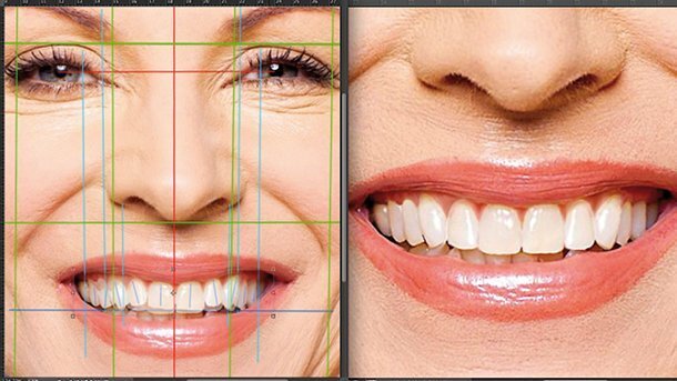 Aesthetic Digital Smile Design ADSD : dentisterie esthétique assistée par ordinateur – Partie II