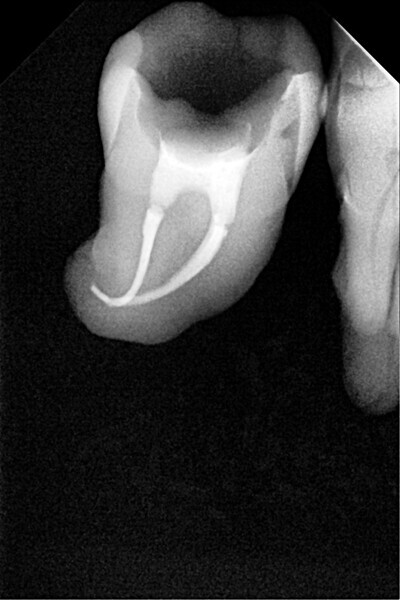 Fig. 24: Radiograph after restoring the space with the fibre-reinforced flowable composite.