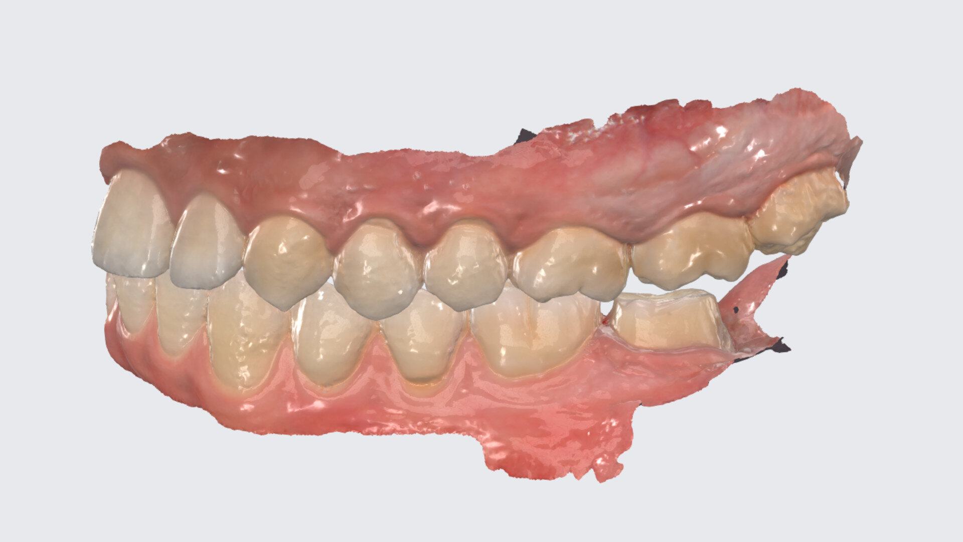AI-based chairside crown design: A single posterior case using Dentbird Crown
