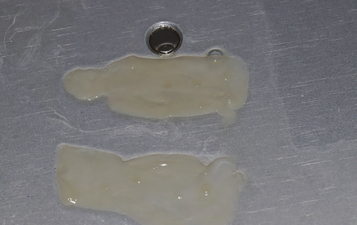 Figure 6: Autologous fibrin membranes easily obtained by removing serum from clot