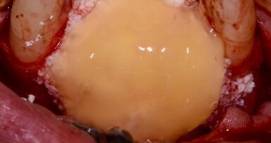 Flusso digitale CAD/CAM in implantologia a carico immediato 3.0