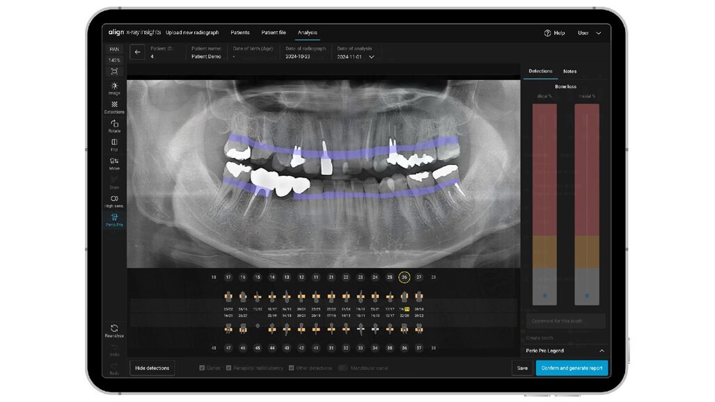 Align Technology lancia in Europa e Regno Unito Align X-ray Insights, un software di rilevamento computerizzato supportato dall’intelligenza artificiale