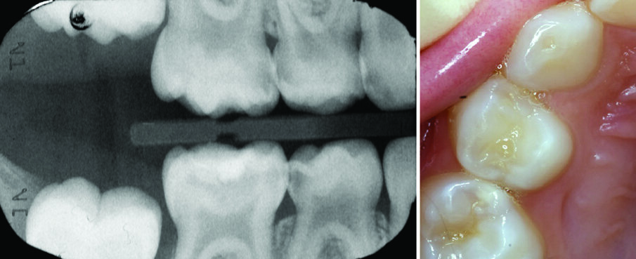 Figures 4 (a) and 4 (b): The Hall technique: Case selection:  Figure 4a: Right Bitewing radiograph shows dentinal caries in teeth 53, 54, 55, 85, 84. Tooth 54 will be used as an example here (All the Es and Ds eventually received SSC using the hall technique). Figure 4b: The same lesion of 54, seen in 4a, is not visible clinically. 