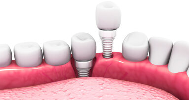 Nanokeramik aus der Kugelmühle für stabilere Zahnimplantate