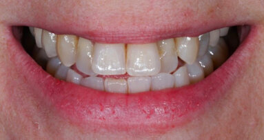 Individualisation of monolithic zirconia restorations