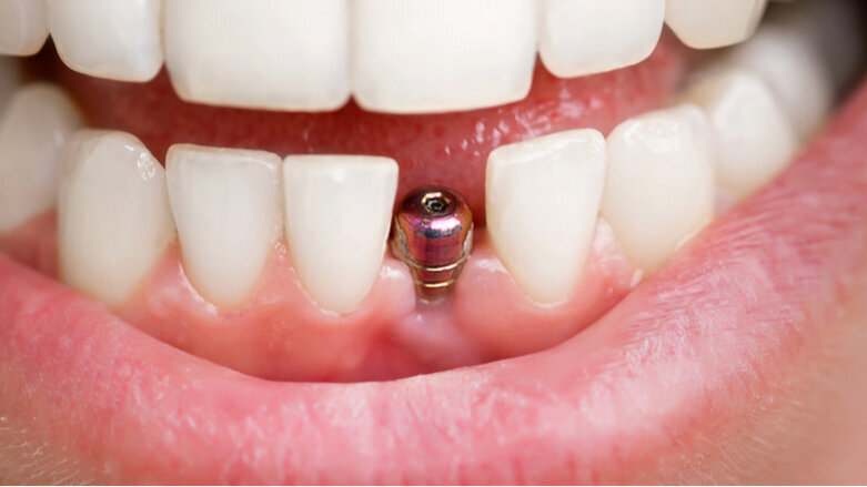 Journal celebrates centennial with article on how implants have influenced restorative dentistry