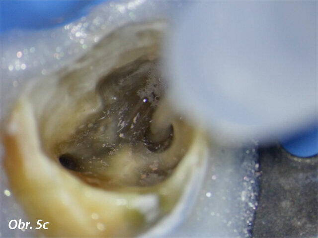 Flexibilní konec vylepšuje ergonomii výplachu a umožňuje oplach kanálkového systému u zubů se složitou anatomií