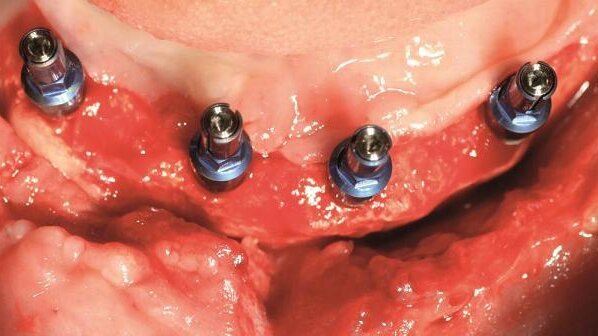 3-D alveolar ridge reconstruction in a case with severe bone loss