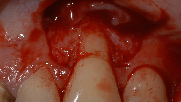 Riabilitazione protesica in area ad alta valenza estetica tra  tecniche tradizionali e digitali