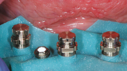 Možnosti ošetření bezzubého oblouku