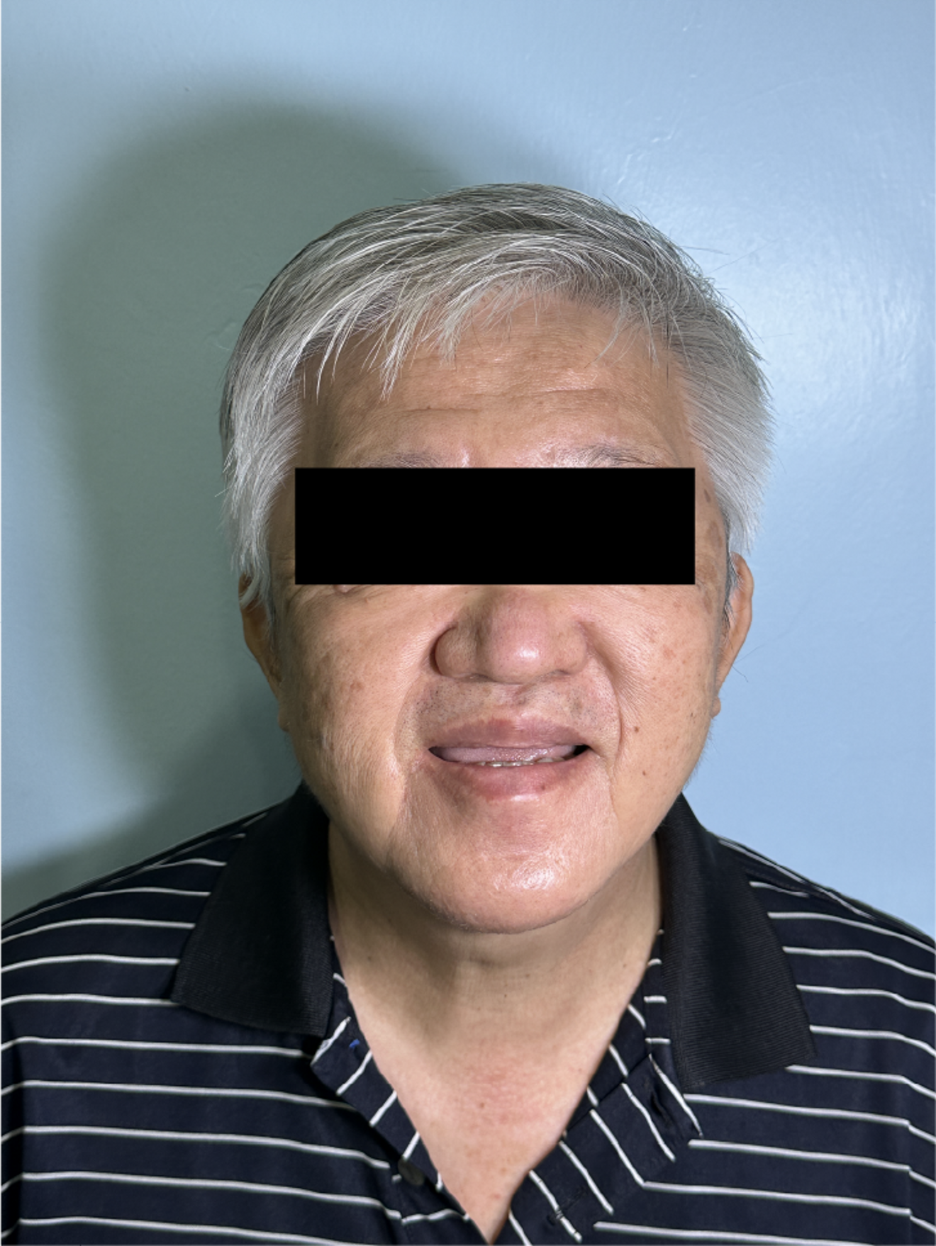 Fig. 1b: Pre-treatment smile view showing an edentulous maxilla and partially edentulous mandible.