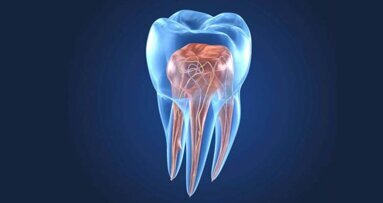 Endodontist highlights tactics to manage complex root canal anatomies