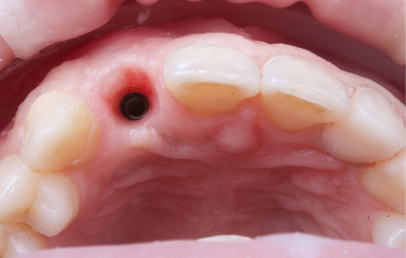 Fig. 7: Tissue healing after implant placement and connective tissue grafting.