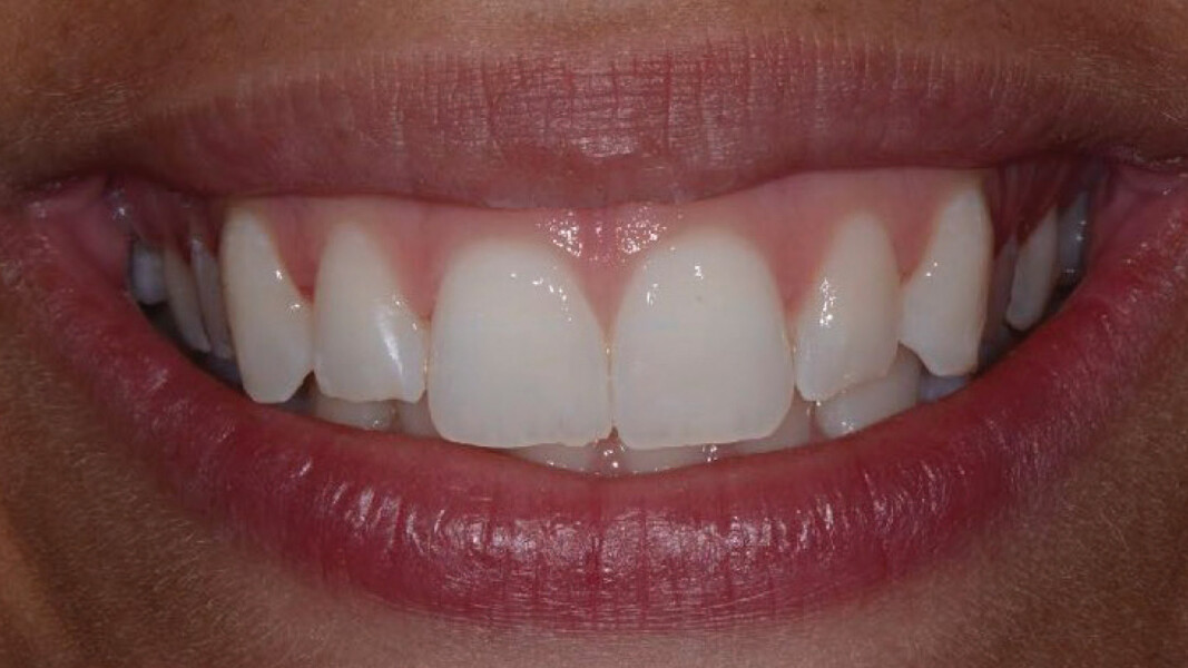 Fig. 17 - Sorriso post trattamento.