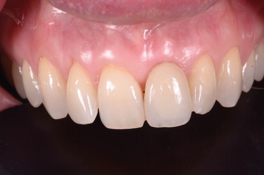 Fig. 9 a: Après une période de cicatrisation de quatre mois