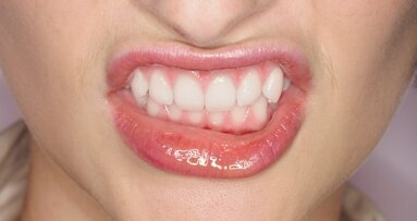 Bruksizm – przyczyny, objawy, leczenie