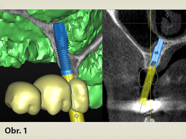 Navigovaná implantace do tenké čelisti