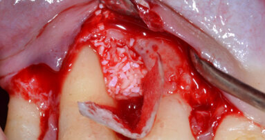 Valutazione di un nuovo inserto ad ultrasuoni in rigenerazione tissutale guidata (GTR)