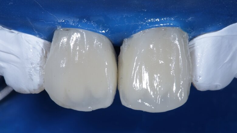 Fig 15 Final enamel layer