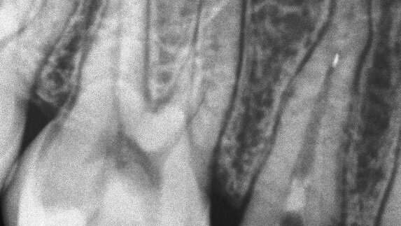 Uklanjanje zalomljenih kanalnih instrumenata – prikaz dva slučaja