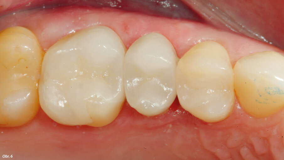 Keramické náhrady po nacementování.