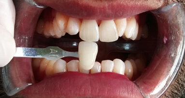 Le blanchiment après nettoyage devient un traitement pour tous